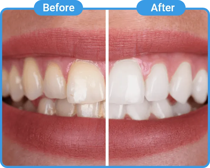 Comparación antes y después de un tratamiento dental