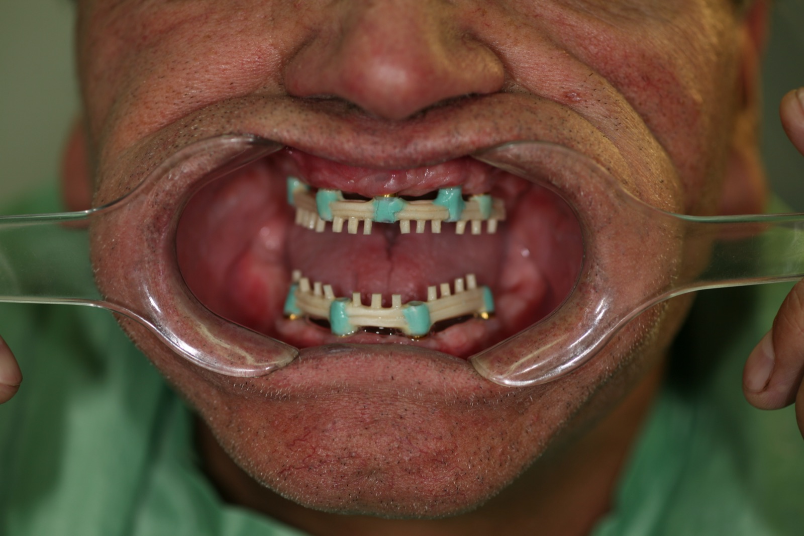 Caso real — paso 2: implantes dentales con cicatrizadores en posición