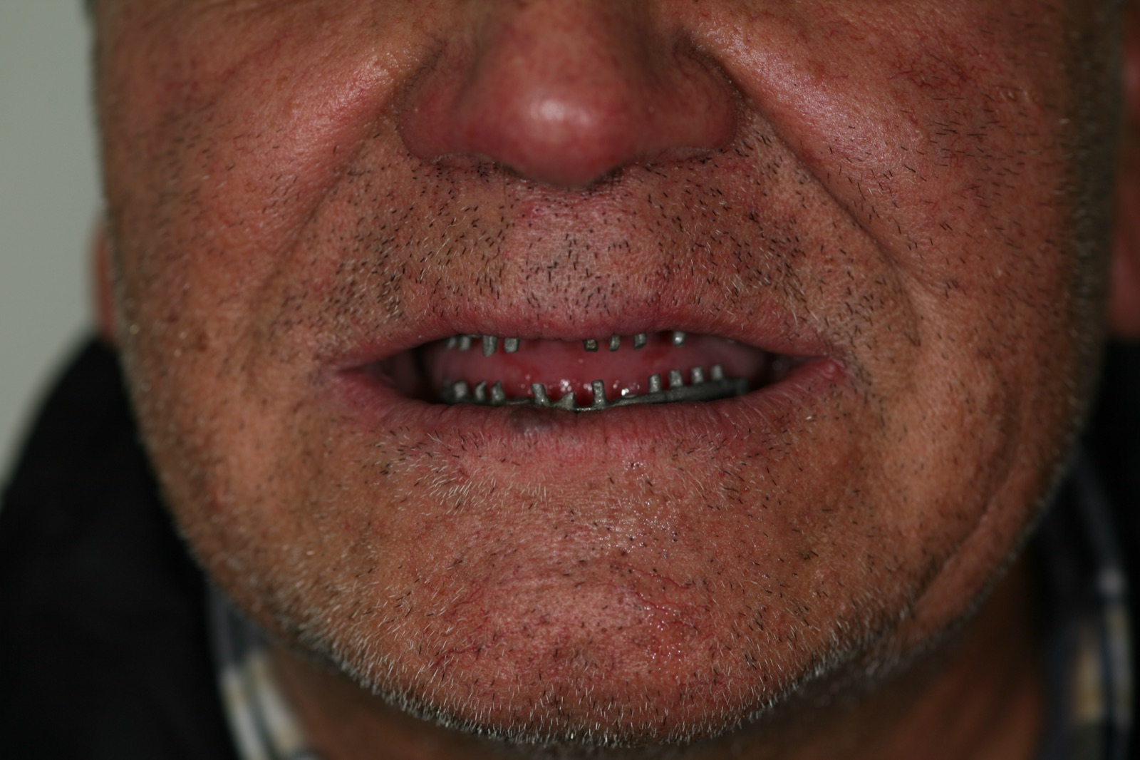 Caso real — paso 3: vista del progreso del tratamiento dental