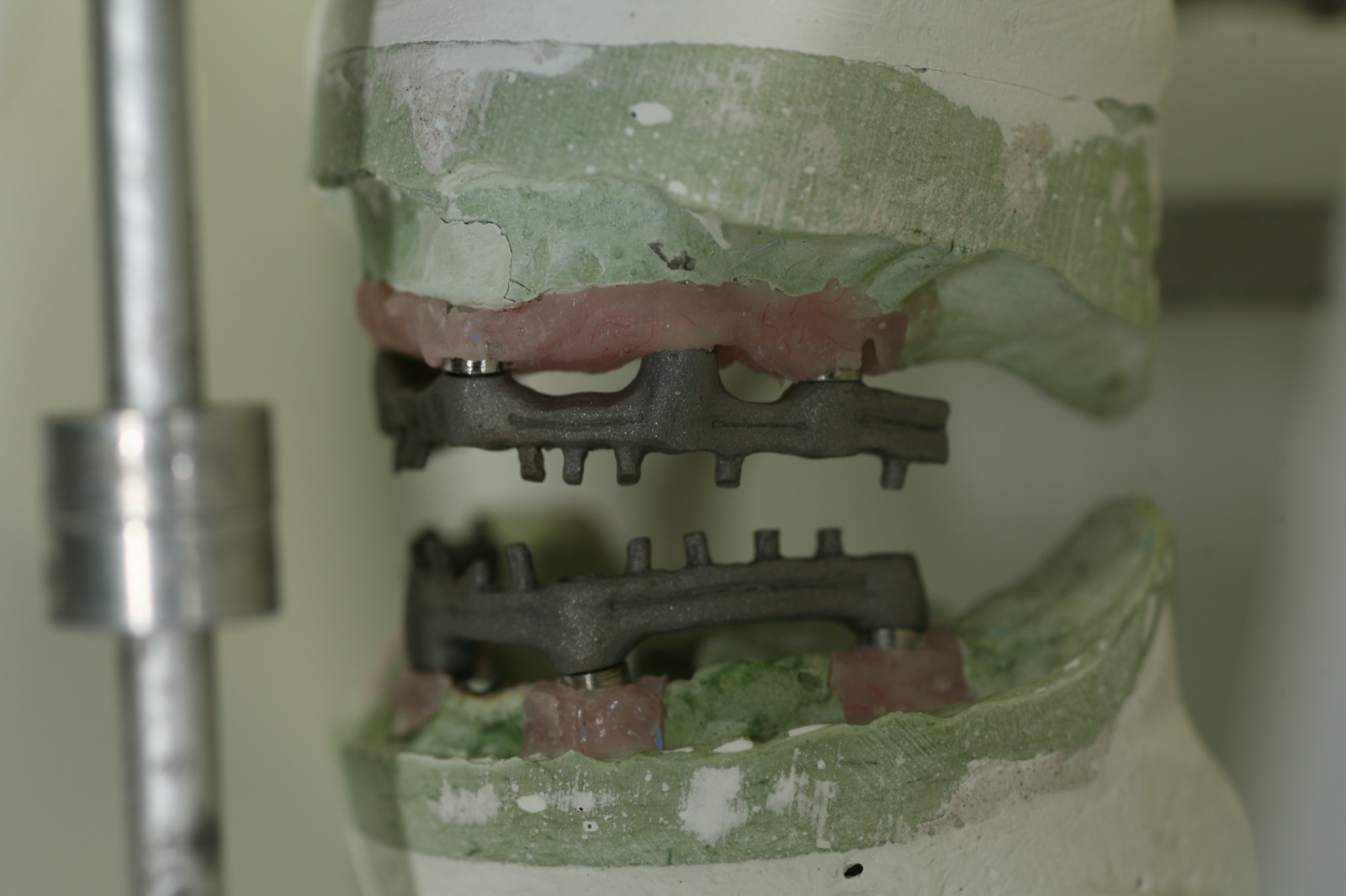 Caso real — paso 4: estructura de implantes sobre modelo de trabajo