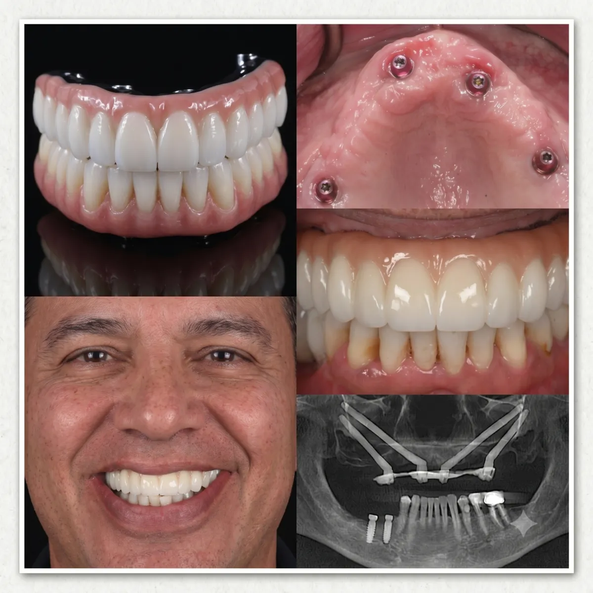 Resultado de tratamiento All-on-X mostrando rehabilitación dental completa de boca