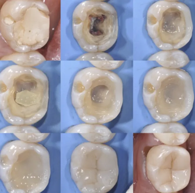 Etapas de restauración biomimética de un diente, mostrando técnica conservadora del tejido natural